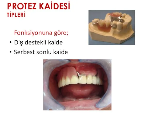 PROTEZ KAİDESİ TİPLERİ Fonksiyonuna göre; Diş destekli kaide Serbest sonlu kaide