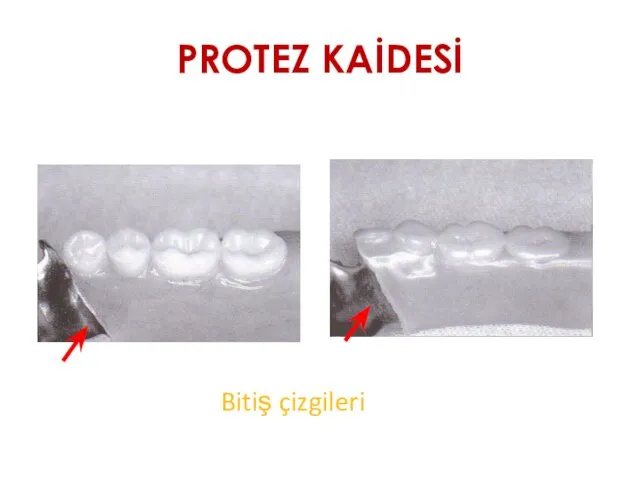 PROTEZ KAİDESİ Bitiş çizgileri