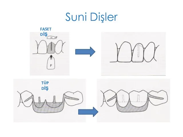 Suni Dişler FASET DİŞ TÜP DİŞ