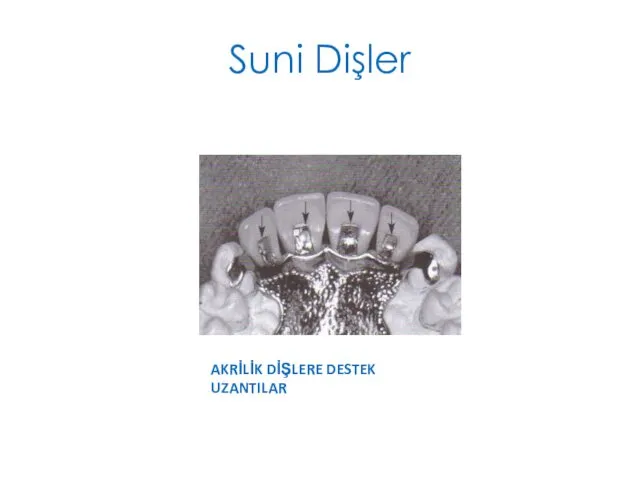 Suni Dişler AKRİLİK DİŞLERE DESTEK UZANTILAR