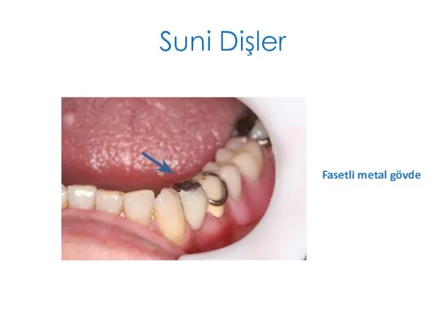 Suni Dişler Fasetli metal gövde