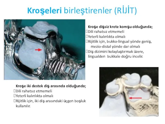 Kroşeleri birleştirenler (RİJİT) Kroşe dişsiz krete komşu olduğunda; Dili rahatsız etmemeli