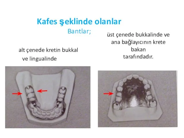 Kafes şeklinde olanlar Bantlar; üst çenede bukkalinde ve ana bağlayıcının krete