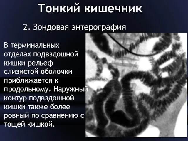 Тонкий кишечник 2. Зондовая энтерография В терминальных отделах подвздошной кишки рельеф