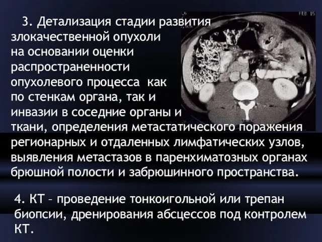 3. Детализация стадии развития злокачественной опухоли на основании оценки распространенности опухолевого