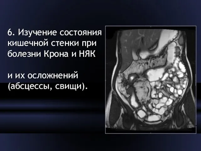 6. Изучение состояния кишечной стенки при болезни Крона и НЯК и их осложнений (абсцессы, свищи).