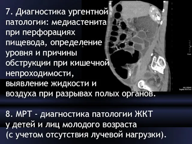 7. Диагностика ургентной патологии: медиастенита при перфорациях пищевода, определение уровня и