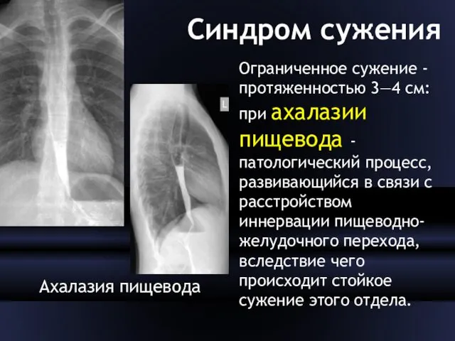 Синдром сужения Ахалазия пищевода Ограниченное сужение - протяженностью 3—4 см: при