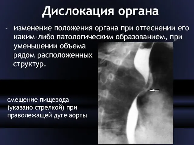 Дислокация органа изменение положения органа при оттеснении его каким-либо патологическим образованием,