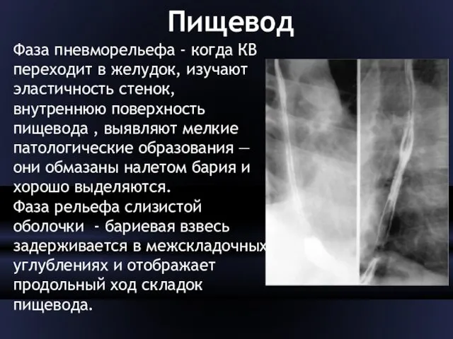 Пищевод Фаза пневморельефа - когда КВ переходит в желудок, изучают эластичность