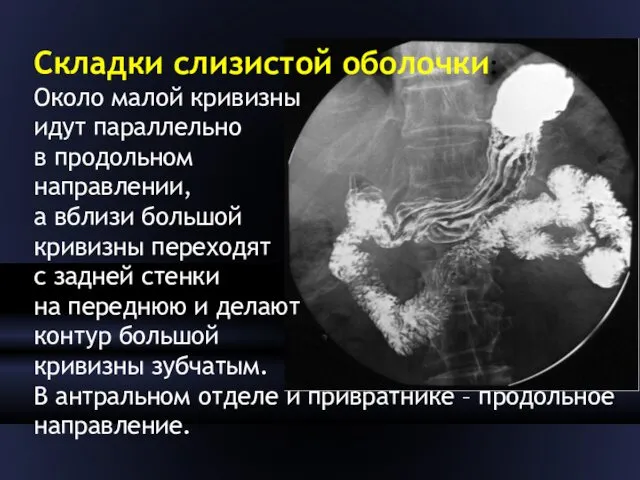 Складки слизистой оболочки: Около малой кривизны идут параллельно в продольном направлении,