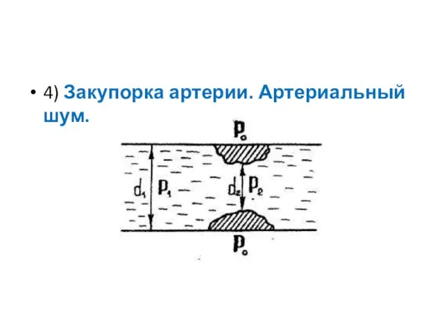 4) Закупорка артерии. Артериальный шум.