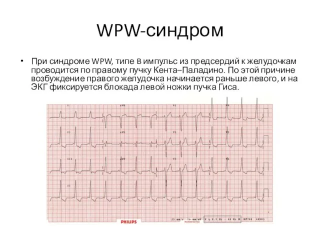 WPW-синдром При синдроме WPW, типе B импульс из предсердий к желудочкам