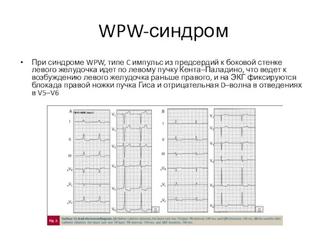 WPW-синдром При синдроме WPW, типе C импульс из предсердий к боковой