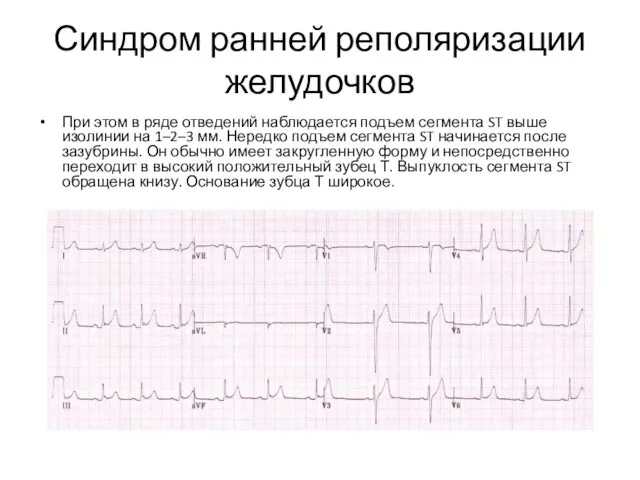 Синдром ранней реполяризации желудочков При этом в ряде отведений наблюдается подъем