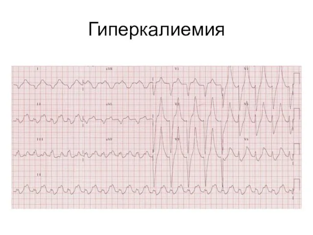 Гиперкалиемия