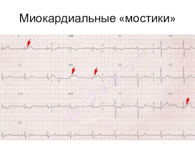 Миокардиальные «мостики»