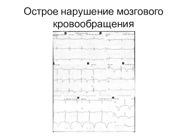 Острое нарушение мозгового кровообращения