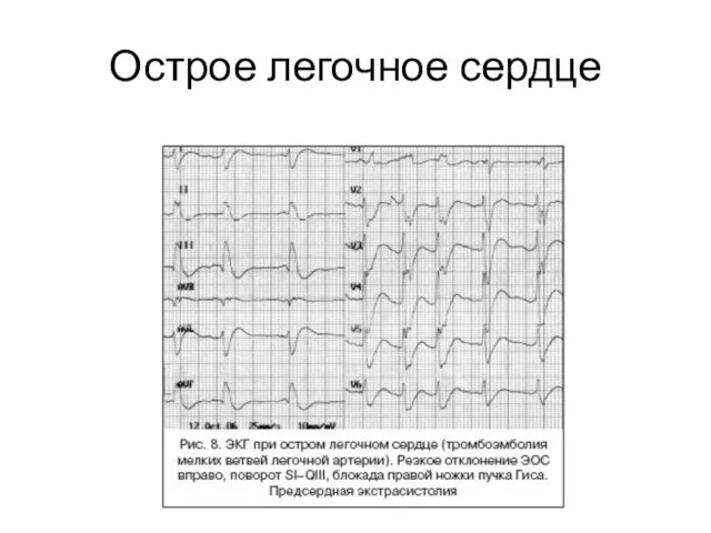 Острое легочное сердце