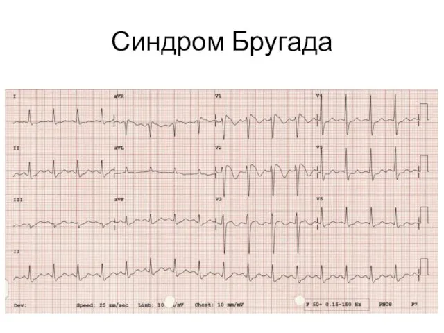 Синдром Бругада