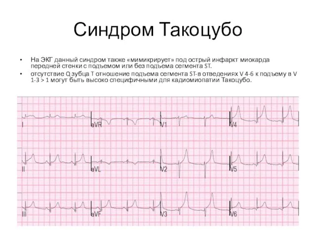 Синдром Такоцубо На ЭКГ данный синдром также «мимикрирует» под острый инфаркт