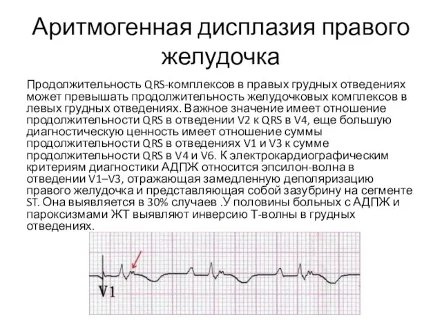 Аритмогенная дисплазия правого желудочка Продолжительность QRS-комплексов в правых грудных отведениях может