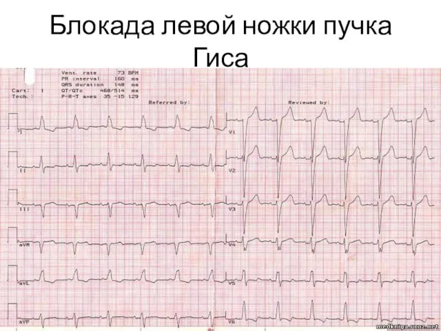 Блокада левой ножки пучка Гиса