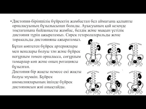 Дистопия-біріншілік бүйректің жамбастан бел аймағына қалыпты орналасуының бұзылысынан болады. Ауысуының қай