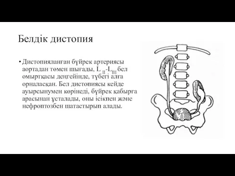 Белдік дистопия Дистопияланған бүйрек артерияcы аортадан төмен шығады, L ІІ-LІІІ бел