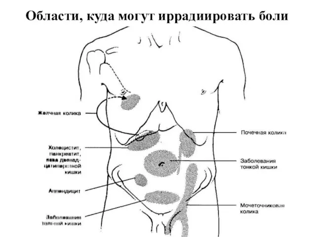 Области, куда могут иррадиировать боли