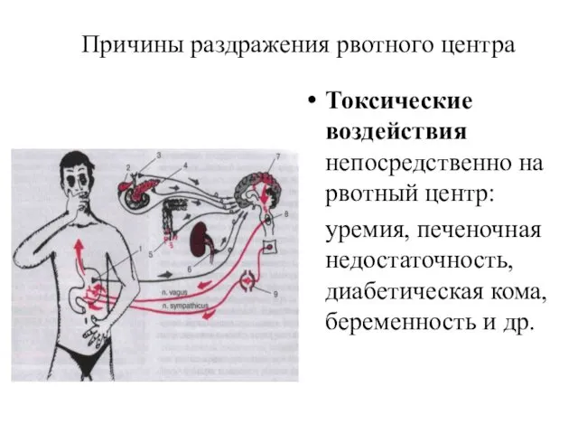 Причины раздражения рвотного центра Токсические воздействия непосредственно на рвотный центр: уремия,