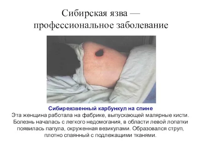Сибирская язва — профессиональное заболевание Сибиреязвенный карбункул на спине Эта женщина
