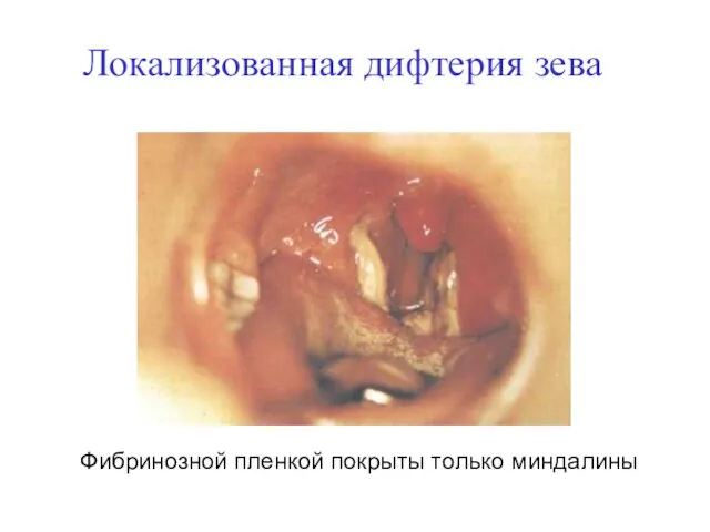 Локализованная дифтерия зева Фибринозной пленкой покрыты только миндалины