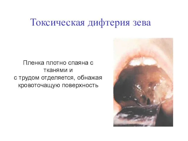 Токсическая дифтерия зева Пленка плотно спаяна с тканями и с трудом отделяется, обнажая кровоточащую поверхность