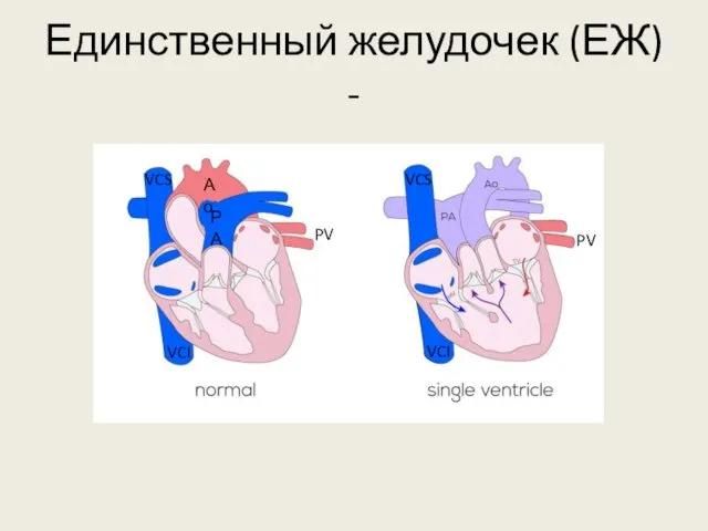 Единственный желудочек (ЕЖ) - РА VCI