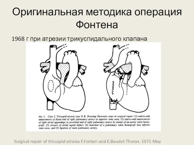 Оригинальная методика операция Фонтена 1968 г при атрезии трикуспидального клапана Surgical