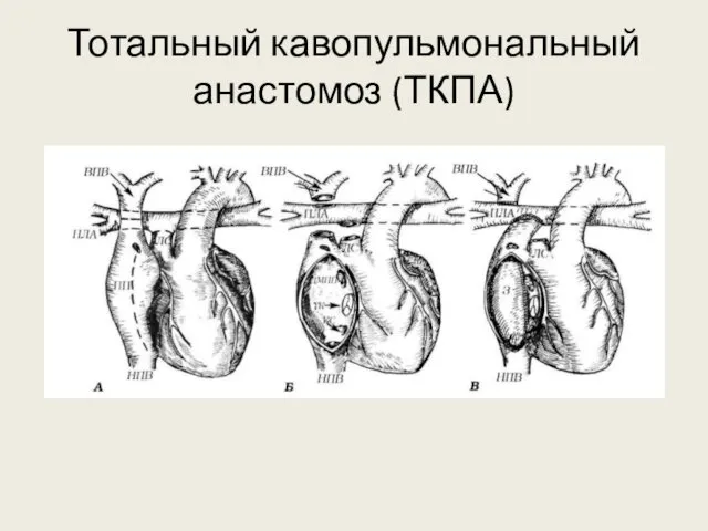 Тотальный кавопульмональный анастомоз (ТКПА)