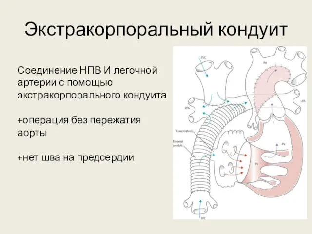 Экстракорпоральный кондуит Соединение НПВ И легочной артерии с помощью экстракорпорального кондуита