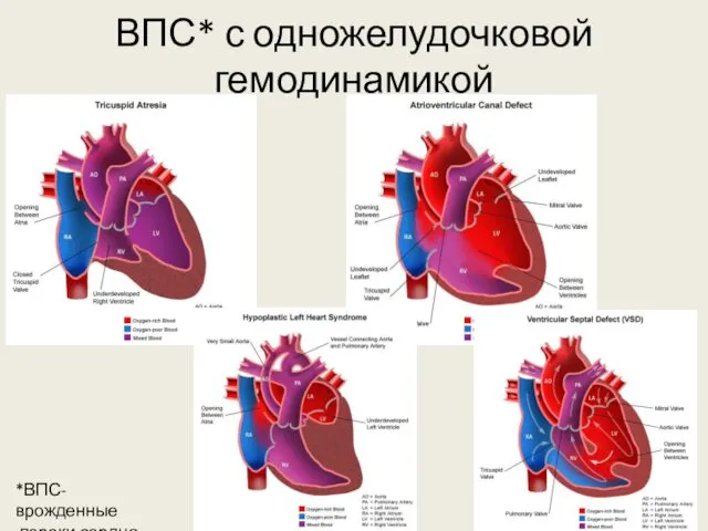 ВПС* с одножелудочковой гемодинамикой *ВПС-врожденные пороки сердца