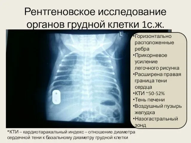 Рентгеновское исследование органов грудной клетки 1с.ж. Горизонтально расположенные ребра Прикорневое усиление