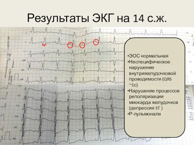 Результаты ЭКГ на 14 с.ж. ЭОС нормальная Неспецифическое нарушение внутрижелудочковой проводимости