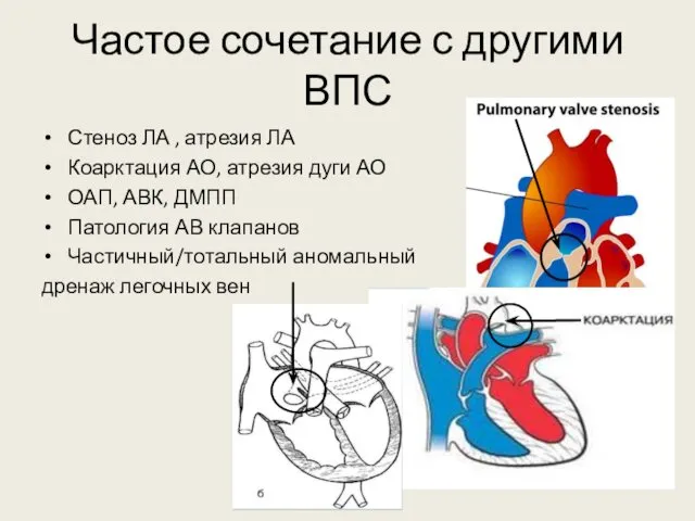 Частое сочетание с другими ВПС Стеноз ЛА , атрезия ЛА Коарктация