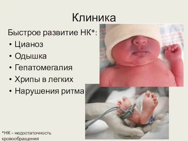 Клиника Быстрое развитие НК*: Цианоз Одышка Гепатомегалия Хрипы в легких Нарушения ритма *НК – недостаточность кровообращения