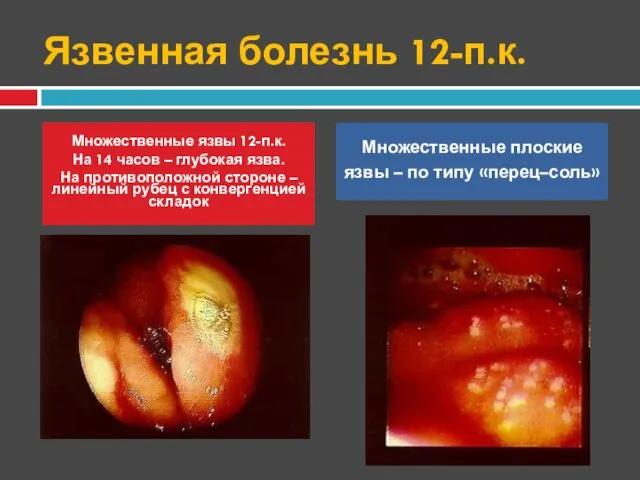 Язвенная болезнь 12-п.к. Множественные язвы 12-п.к. На 14 часов – глубокая