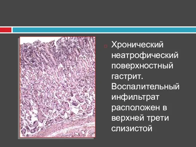 Хронический неатрофический поверхностный гастрит. Воспалительный инфильтрат расположен в верхней трети слизистой