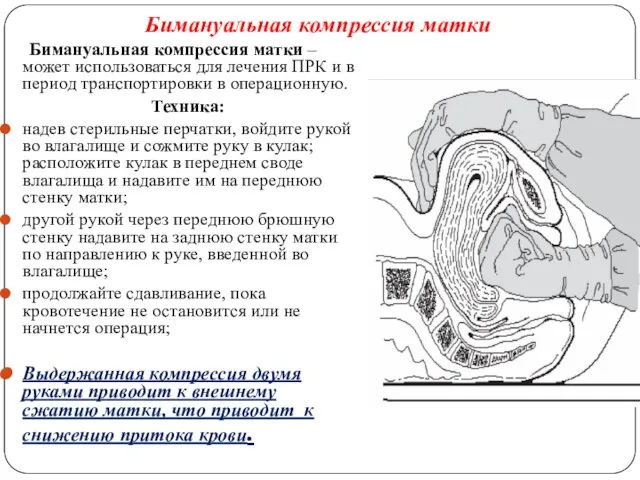 Бимануальная компрессия матки – может использоваться для лечения ПРК и в