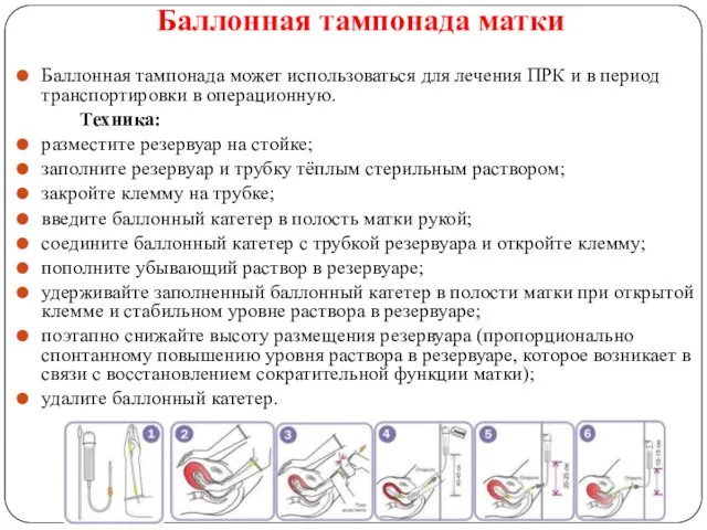 Баллонная тампонада матки Баллонная тампонада может использоваться для лечения ПРК и