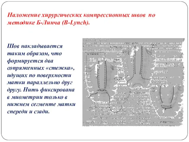 Наложение хирургических компрессионных швов по методике Б-Линча (B-Lynch). Шов накладывается таким