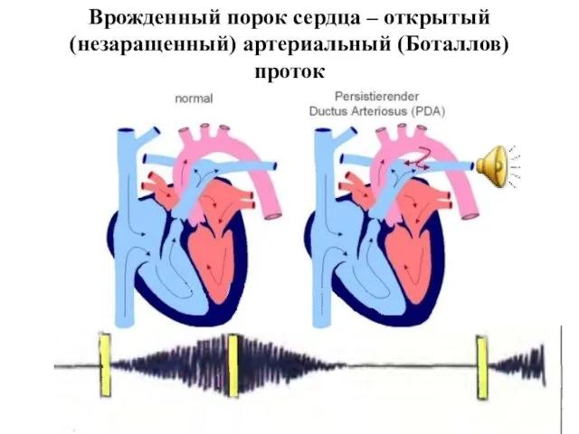 Врожденный порок сердца – открытый (незаращенный) артериальный (Боталлов) проток