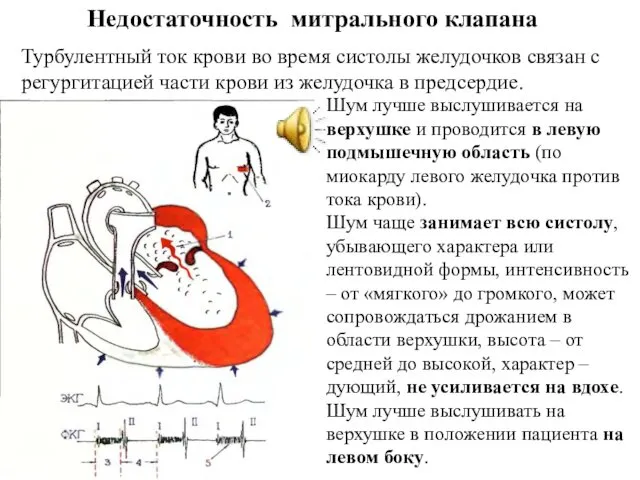 Недостаточность митрального клапана Турбулентный ток крови во время систолы желудочков связан